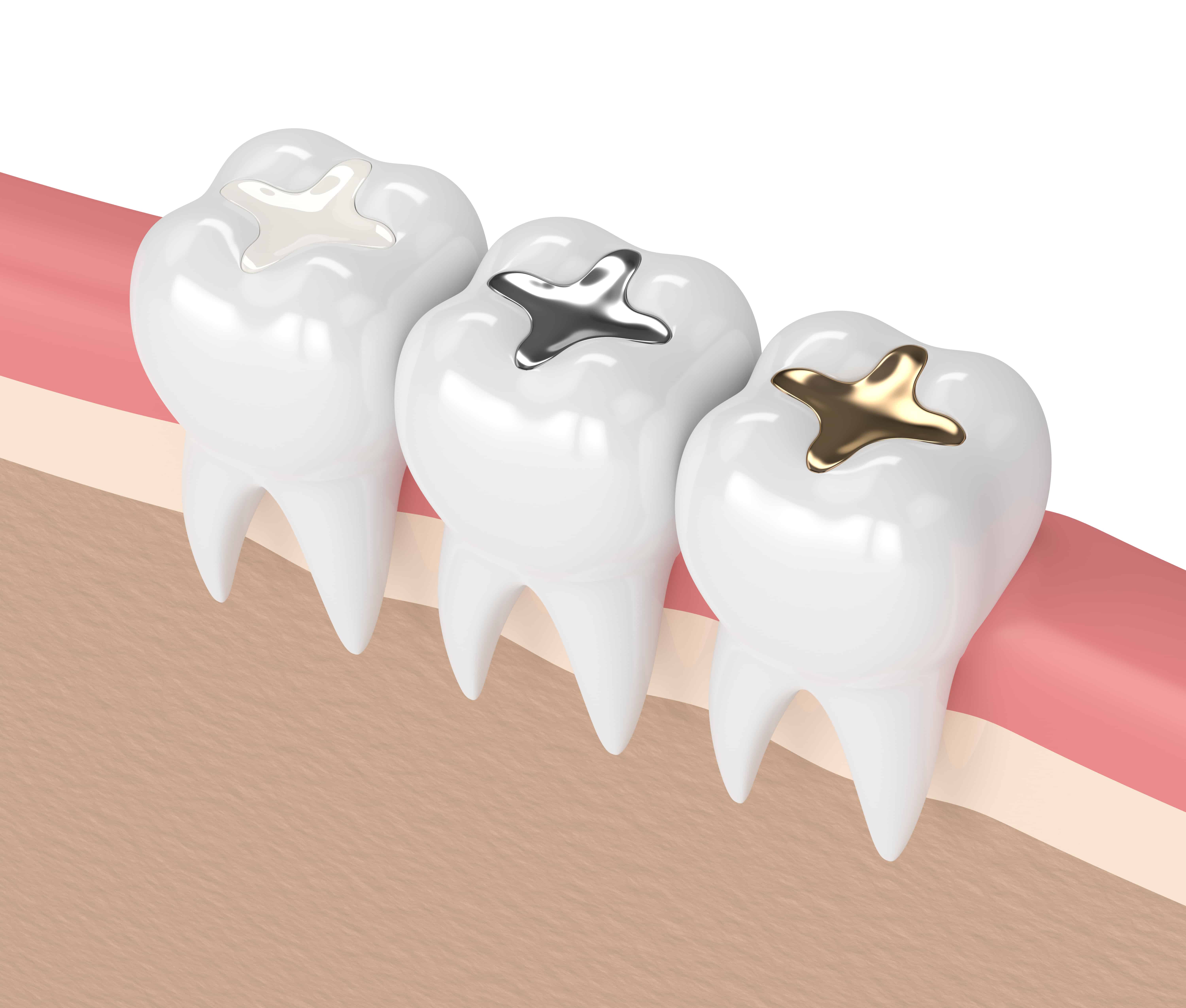 The No. 1 tooth prosthesis Mistake You're Making