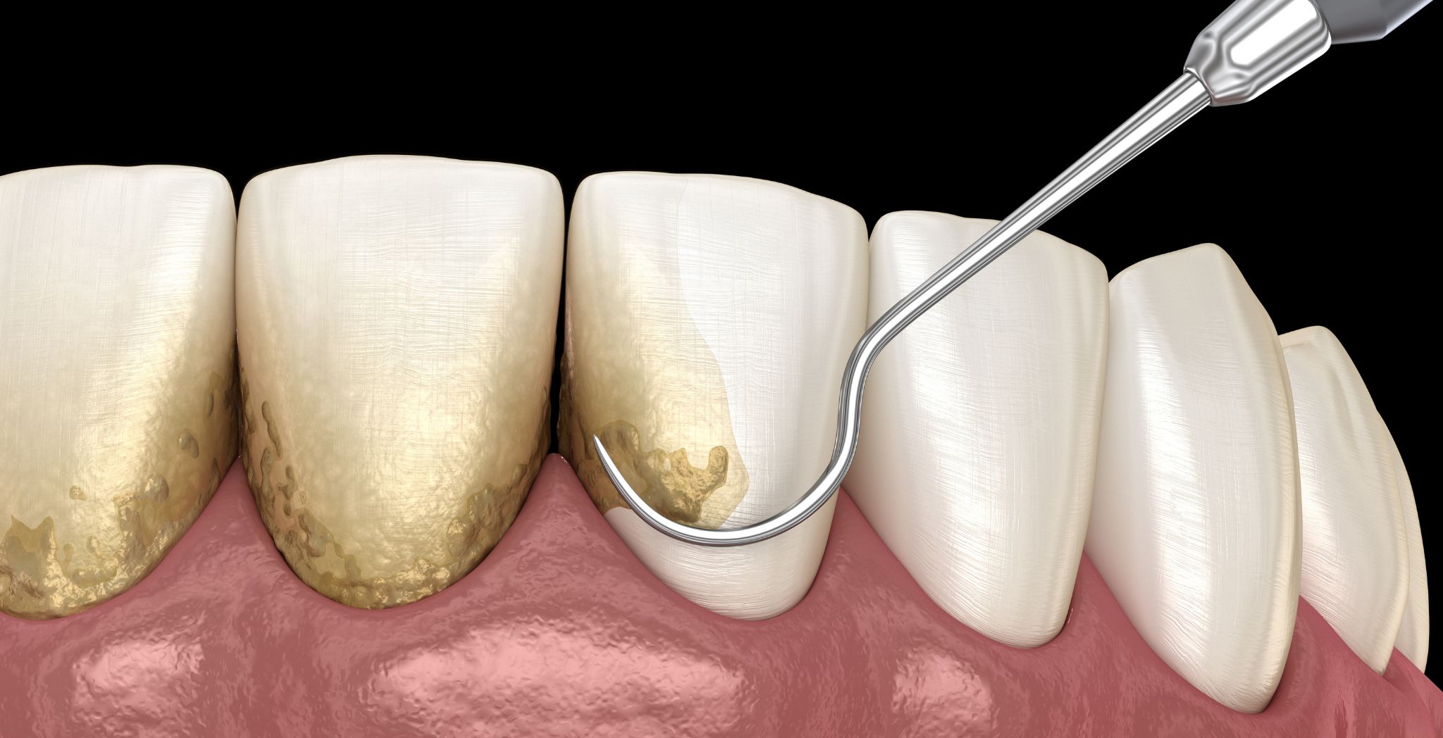 Periodontal cleaning procedure, Deep dental cleaning, Gum disease treatment, Scaling & root planing