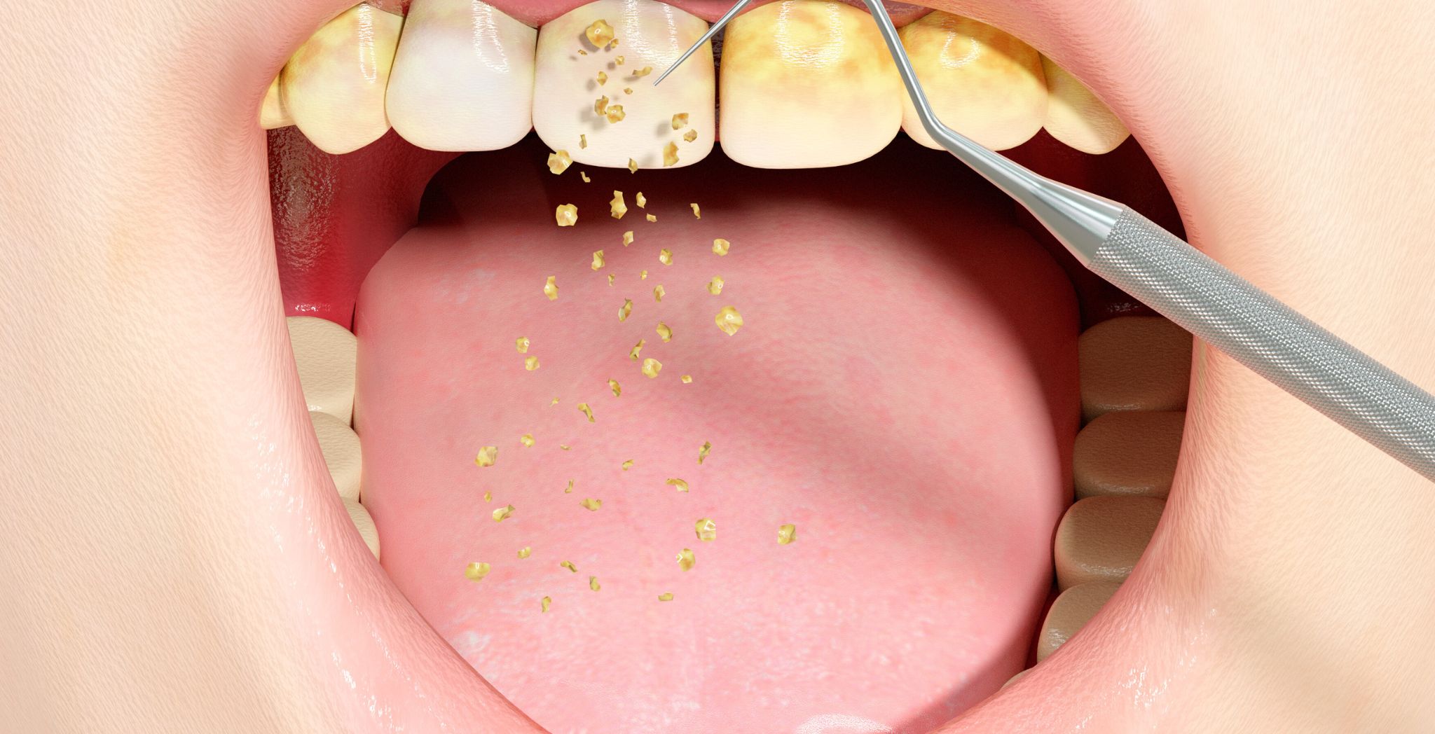 Tartar Calculus removal procedure, Calculus removal from teeth, Dental cleaning for tartar