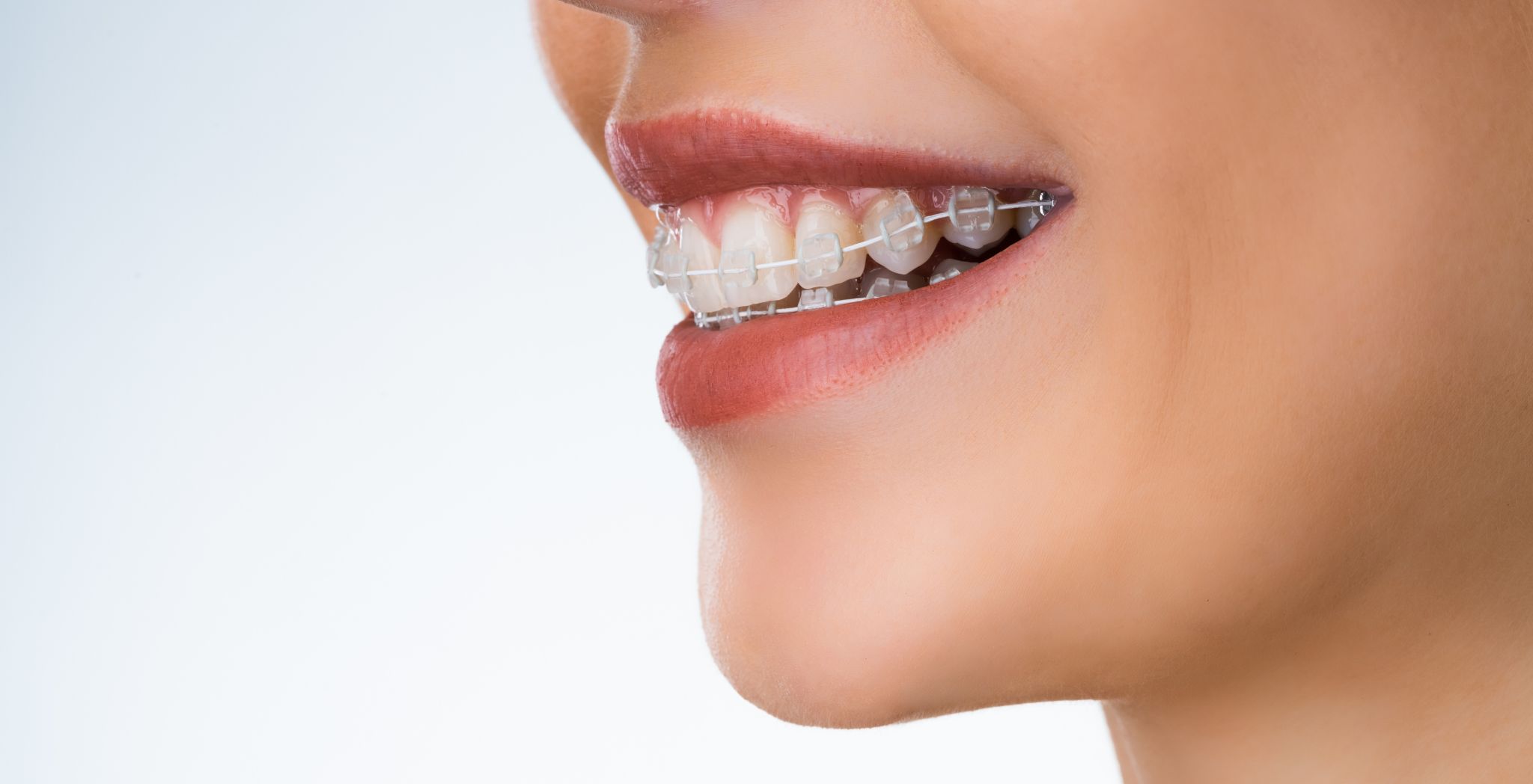 How to fix overbite, Overbite correction methods, Treating dental overbite, Braces for overbite
